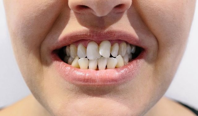 Çarpık dişin sağlığa zararı var mı?